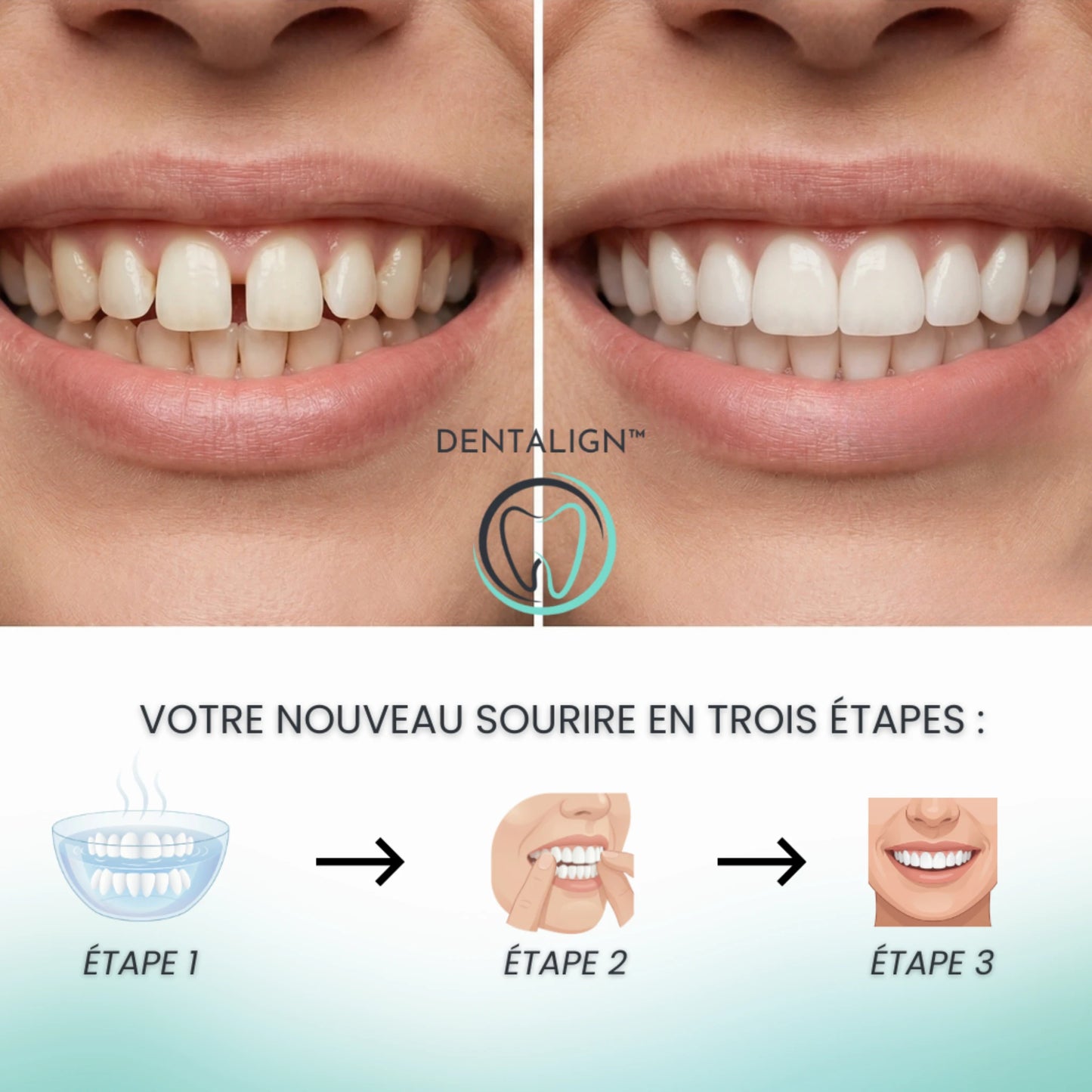 Facettes Amovibles - Dentalign™